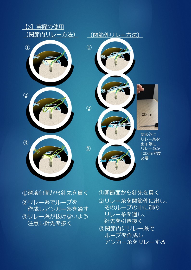 スーチャースティンガーRC